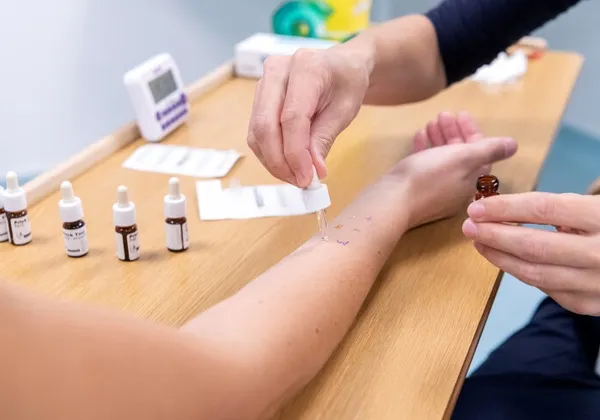 Skin prick (allergy) test
