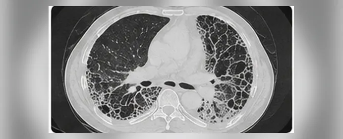 Chest X-ray showing old tuberculosis scarring of the lung
