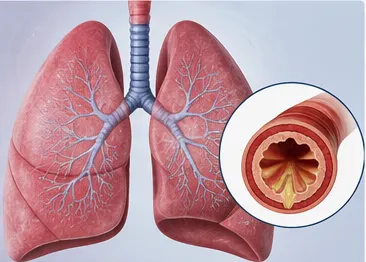 Asthma–COPD overlap
