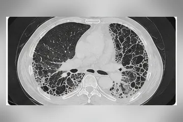 HRCT images showing progression of lung fibrosis over time