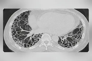 HRCT showing honeycombing typical of idiopathic pulmonary fibrosis