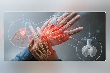 Swollen joints in connective tissue disease associated ILD