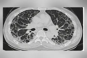 Bird and mould exposure causing hypersensitivity pneumonitis